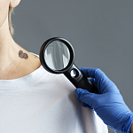 Удаление новообразований (родинок, бородавок)